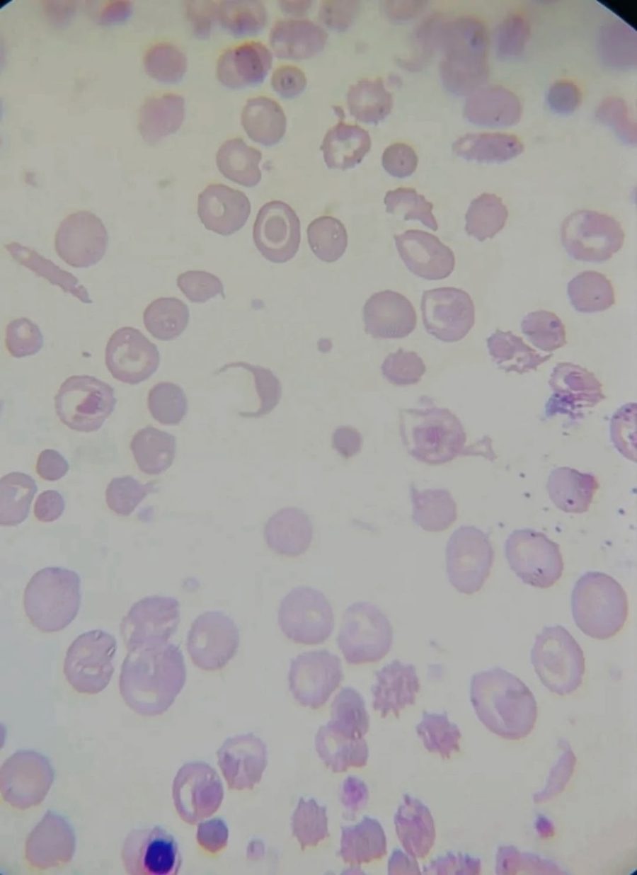 Нормобластоз и пойкилоцитоз в мазке крови при бета-талассемии