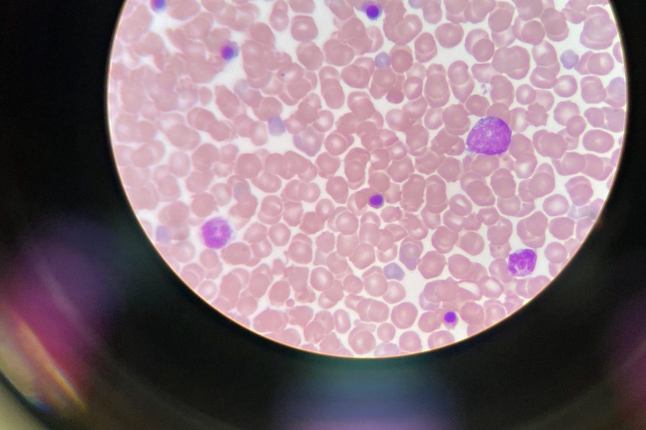 Normoblasts in Neonatal Peripheral Blood: A Case Study