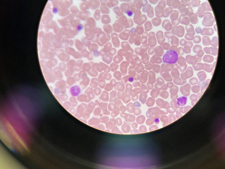 Neonatal blood smear: normoblasts and a leukocyte in the field of view