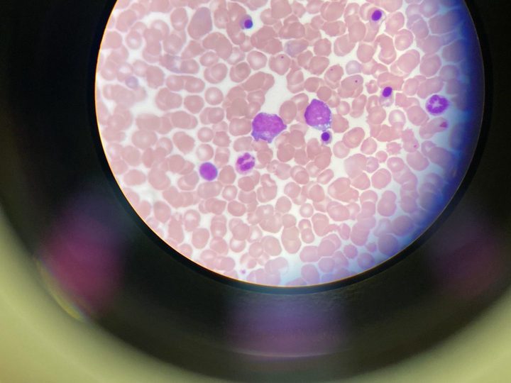 Blood smear: oxyphilic normoblasts and granulocytes of a neonate