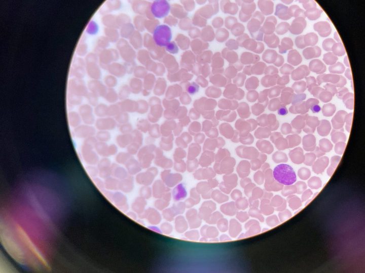 Neonatal blood smear: normoblasts with dense round nuclei