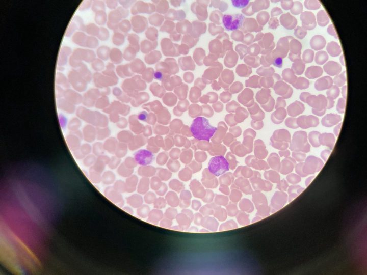 Blood smear: cluster of nucleated red blood cells and leukocytes