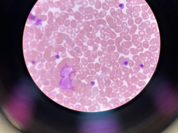 Blood smear: normoblasts with pyknotic nuclei and a disintegrated leukocyte