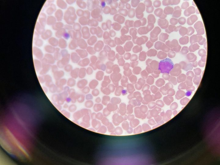 Blood smear: nucleated erythroid cells in a neonate