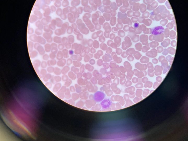 Blood smear: normoblasts and a segmented neutrophil in the field of view