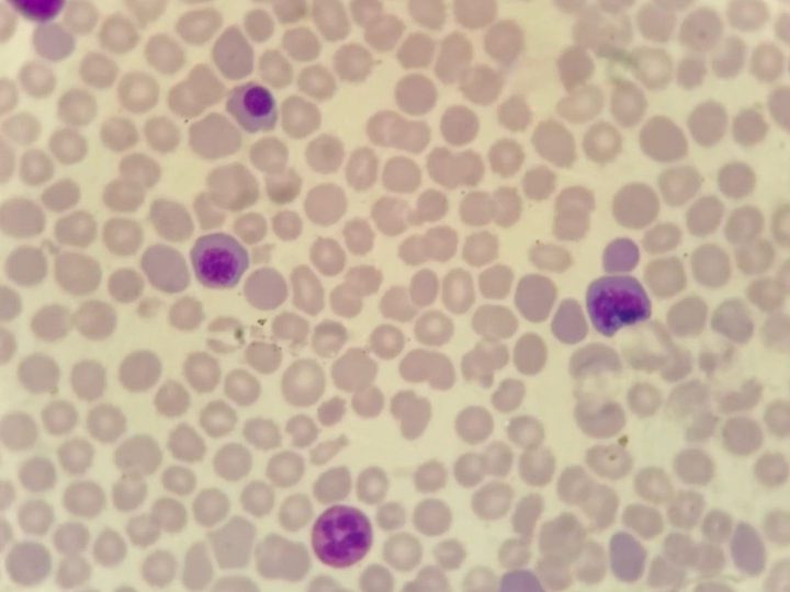 Мазок периферической крови: скопление эритрокариоцитов и зрелых гранулоцитов