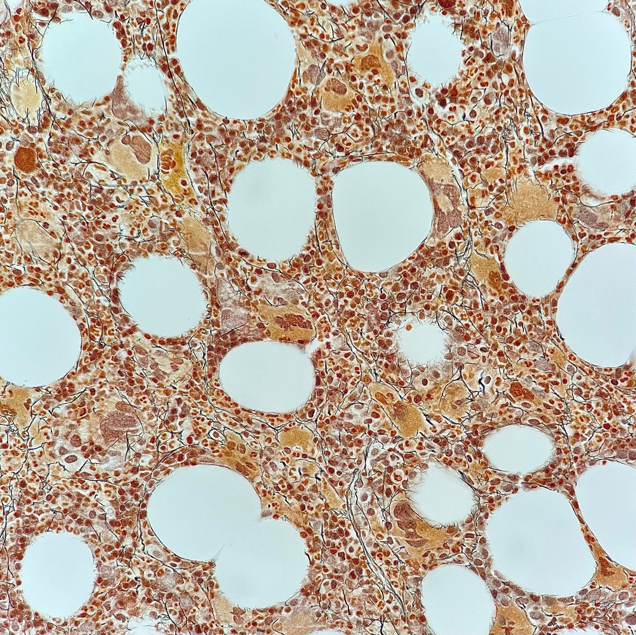Bone Marrow Fibrosis Assessment: Gordon-Sweet Stains MF-1, MF-3