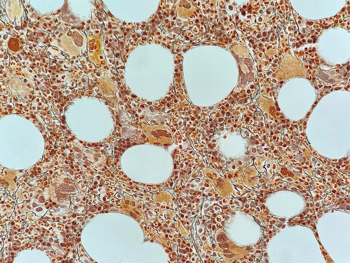 Bone marrow histological section: reticulin fibers, MF-1 stage