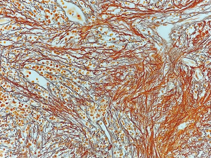 Bone marrow histological section: coarse collagen fibrosis, MF-3 stage