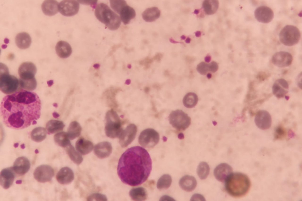 Platelet Assessment in Blood Smear with Severe Anemia