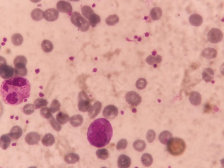Blood smear, monocyte, neutrophil, and visual platelet aggregation