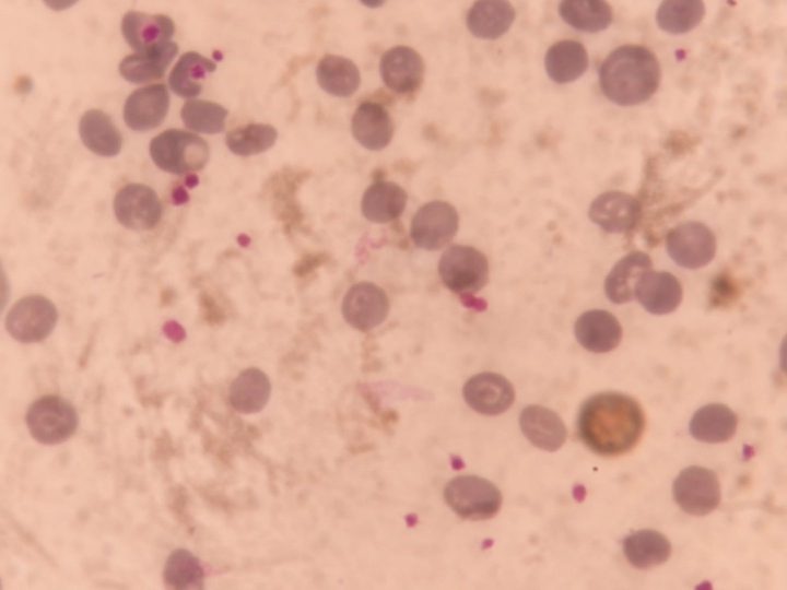 Blood smear, sparse erythrocyte distribution and platelets
