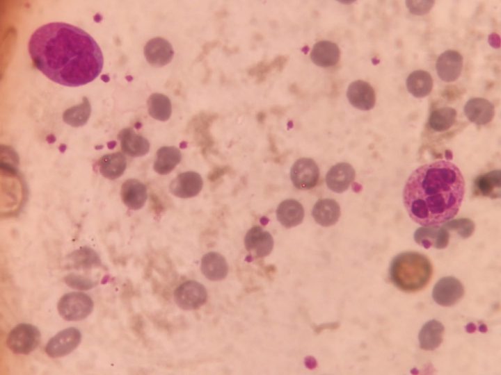 Blood smear, leukocytes and platelets in severe erythropenia