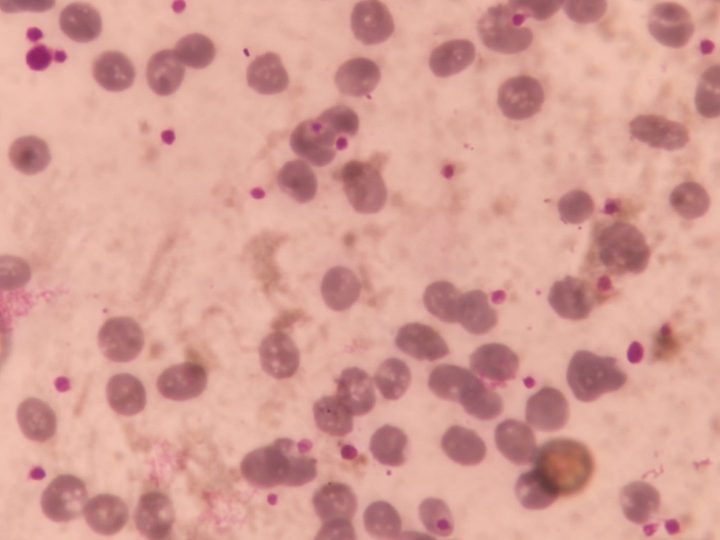 Blood smear, visual predominance of platelets against a background of anemia