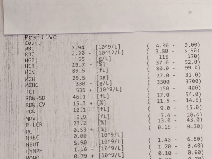 Analyzer printout, severe anemia HGB 65 g/L and PLT 535