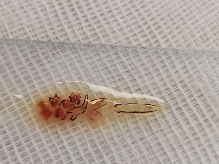 Adult Opisthorchis fluke recovered by duodenal intubation