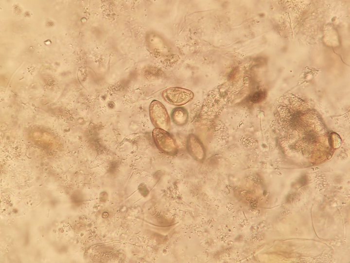 Opisthorchis eggs in duodenal contents