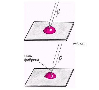 Morawitz Coagulation Time Test: Principle and Procedure