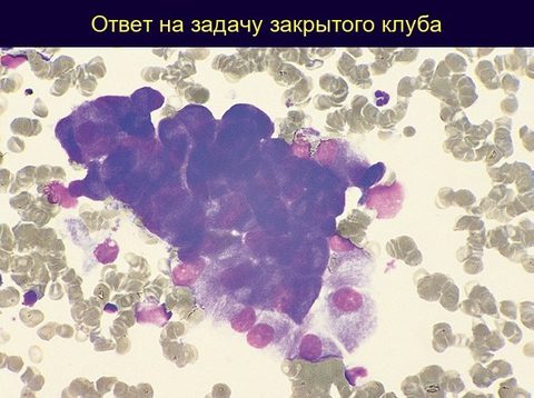 Мазок костного мозга: скопление нормальных остеобластов