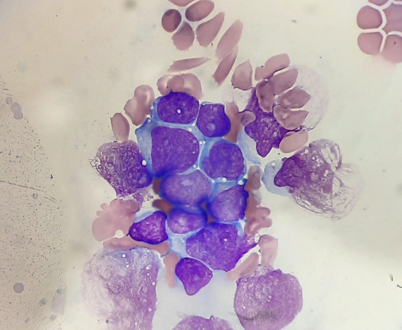 Pediatric B-Lymphoblastic Leukemia: A Diagnostic Case Study