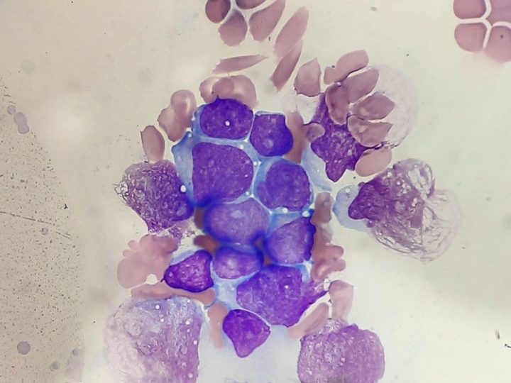 Bone marrow smear: cluster of lymphoblasts with delicate chromatin