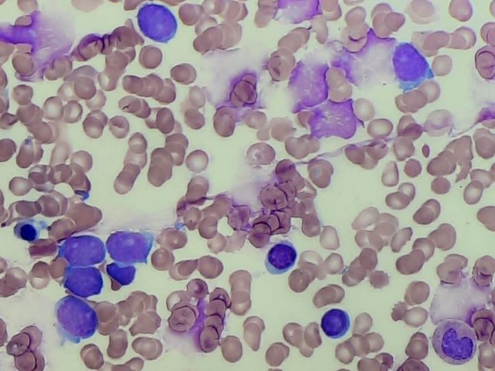 Bone marrow smear: total infiltration with blast elements