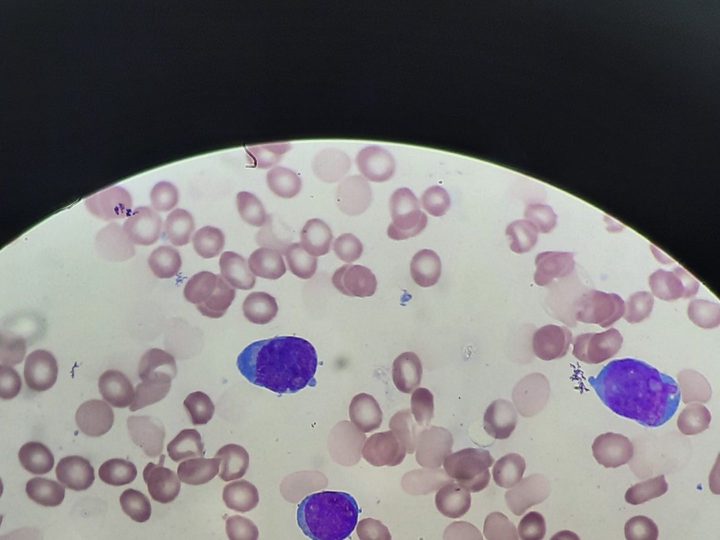 Peripheral blood smear: mature lymphocytes, no blasts detected