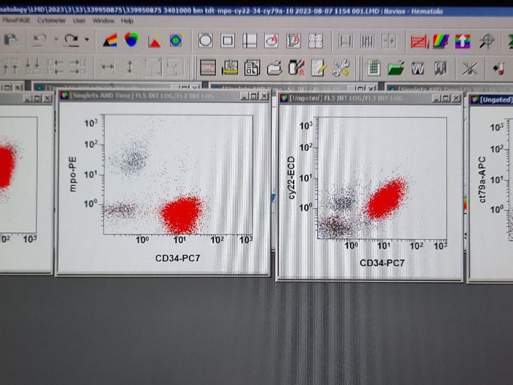 Flow cytometry: expression of TdT, CD10, cyCD22, and cyCD79a