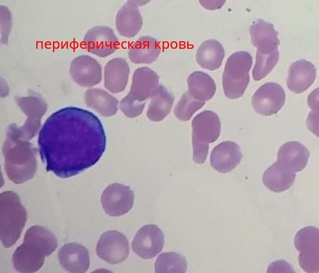 Острый эритроидный лейкоз: морфология и иммунофенотип