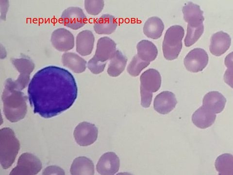 Мазок периферической крови: бластоподобная клетка с базофильной цитоплазмой