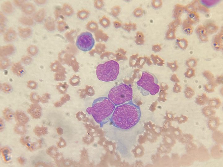 Мазок крови: группа бластных клеток и единичный мелкий лимфоцит