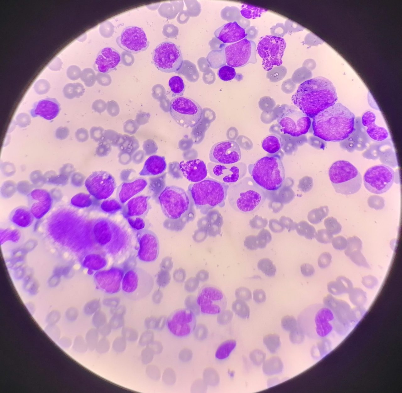 Acute Leukemia: Blood Smear and Bone Marrow Aspirate