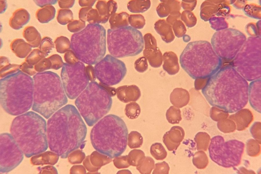 Acute Leukemia in a Rat: Blast Morphology in Blood Smear