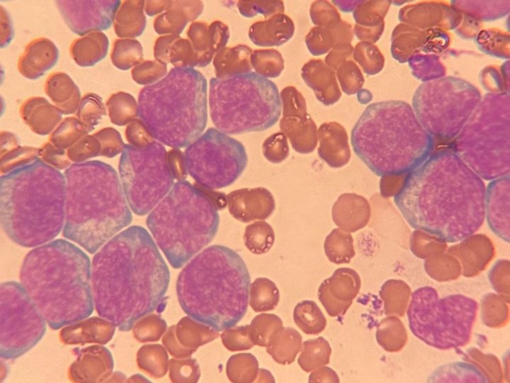 Rat blood smear: cluster of large blast cells, Romanowsky stain, x1000