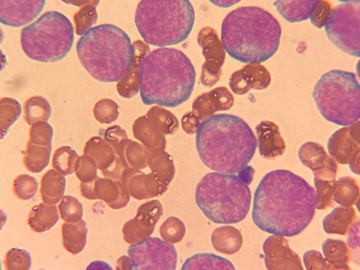 Rat blood smear: pronounced blastosis with leukocytosis of 258 thousand/µL, x1000