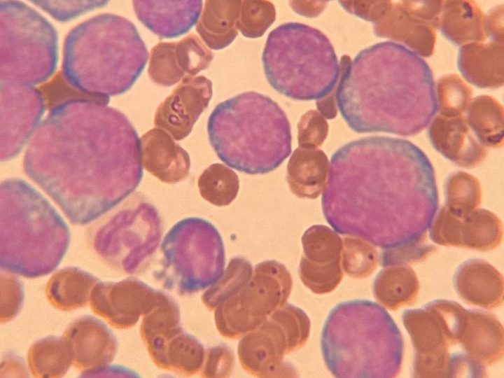 Blood smear: atypical monomorphic blasts with a narrow rim of cytoplasm, x1000