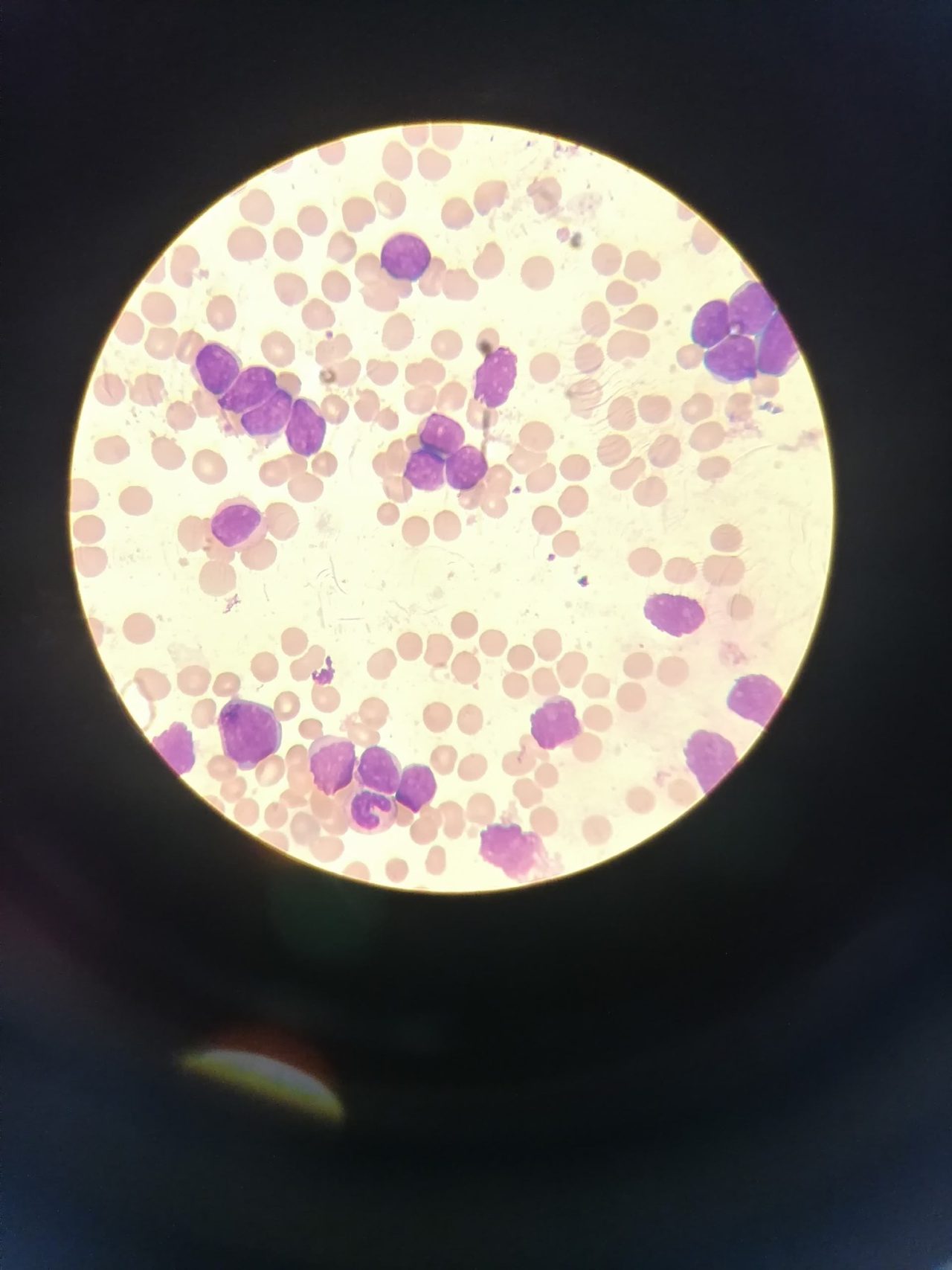 Blood smear: pronounced leukocytosis with a predominance of blast cells