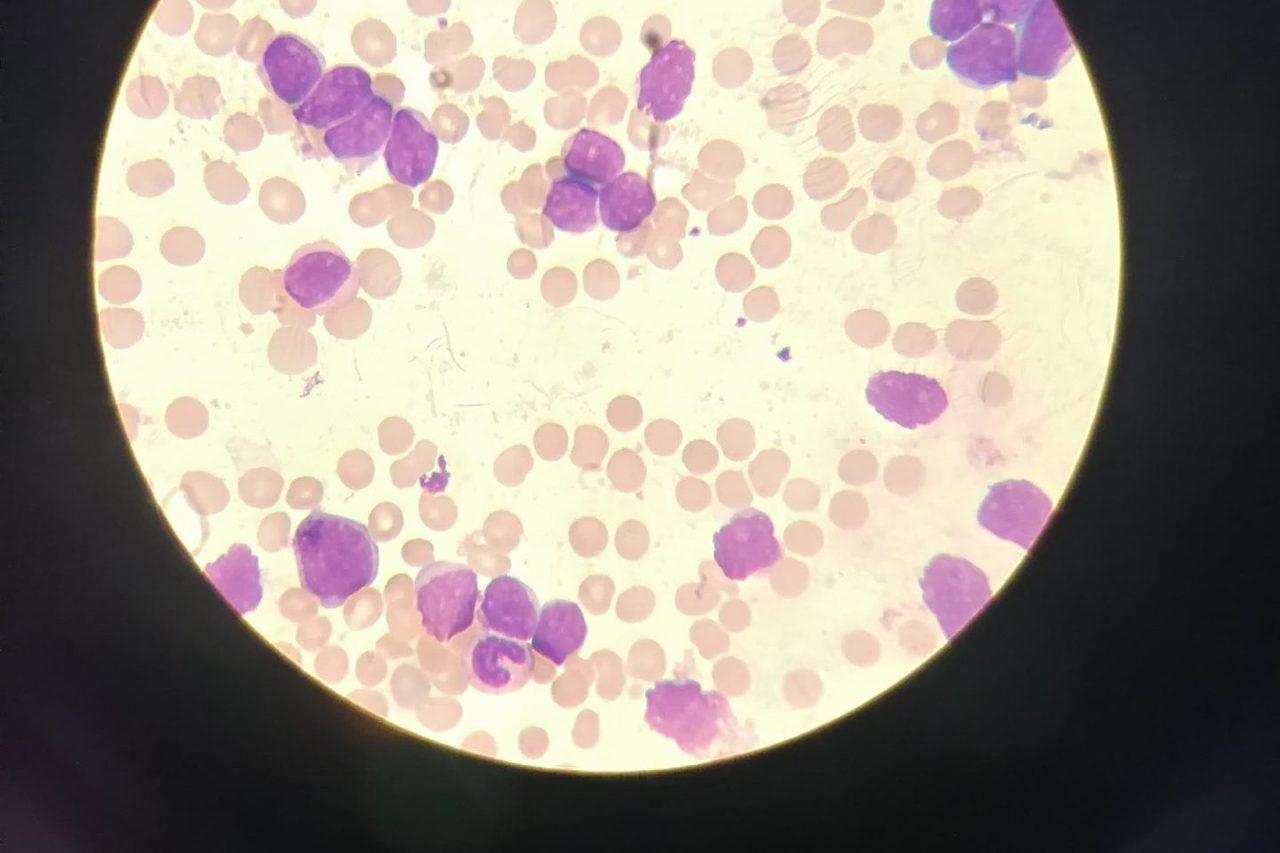 Acute Leukemia in a Child: Blastemia and Hyperleukocytosis
