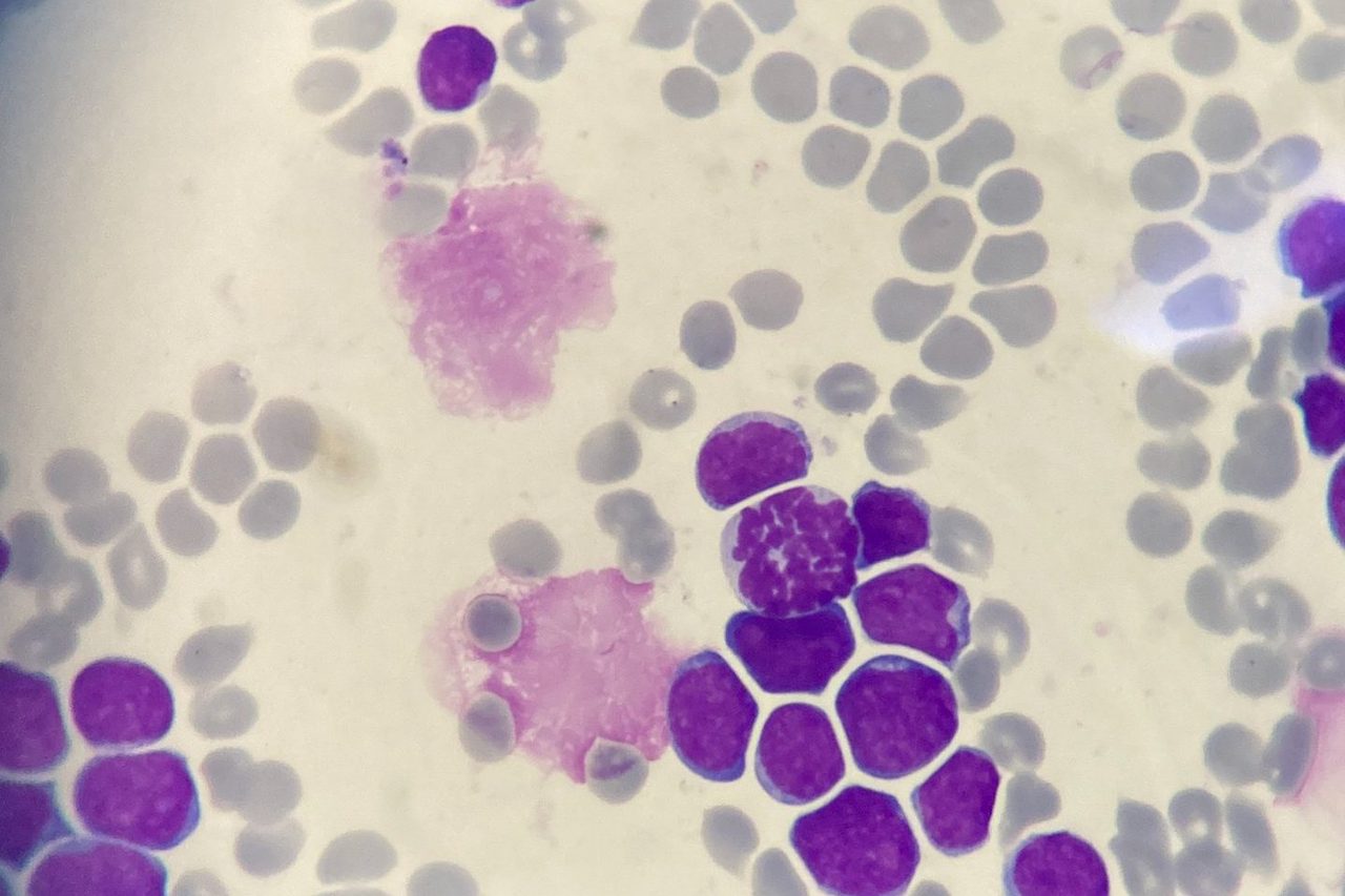 Acute Leukemia in a Child: Blasts in Peripheral Blood