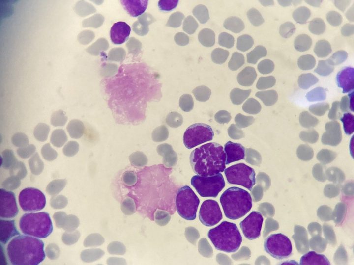 Blood smear, accumulation of blast cells and shadows of destroyed elements