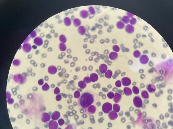 Blood smear, pronounced leukocytosis with blast predominance