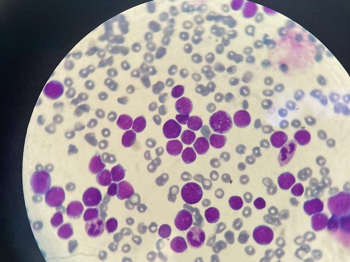 Blood smear, blast cells of various sizes and a single neutrophil