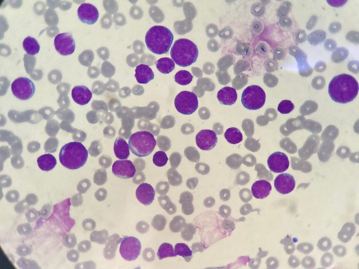 Blood smear, monomorphic blast population against a background of single cell shadows