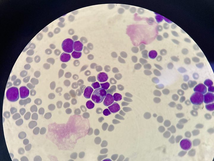 Blood smear, accumulation of blasts and destroyed cellular elements