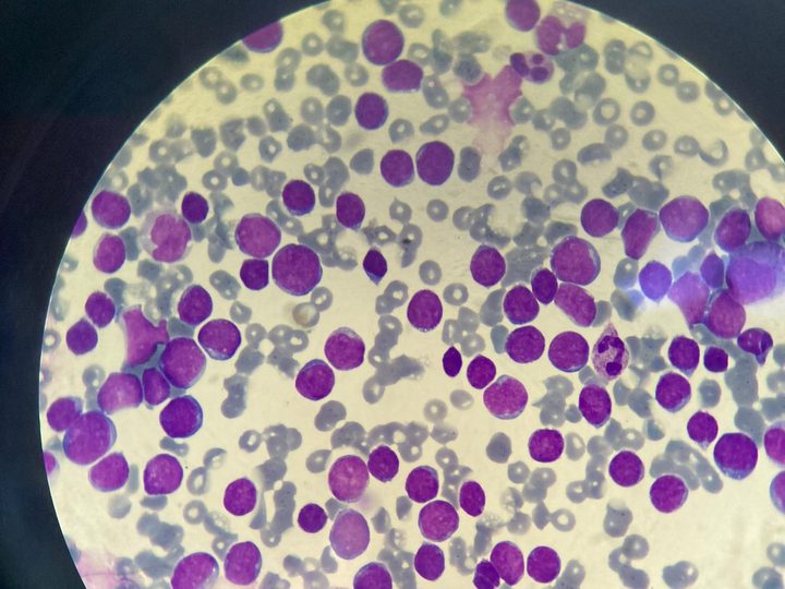 Blood smear, high concentration of blast cells in hyperleukocytosis