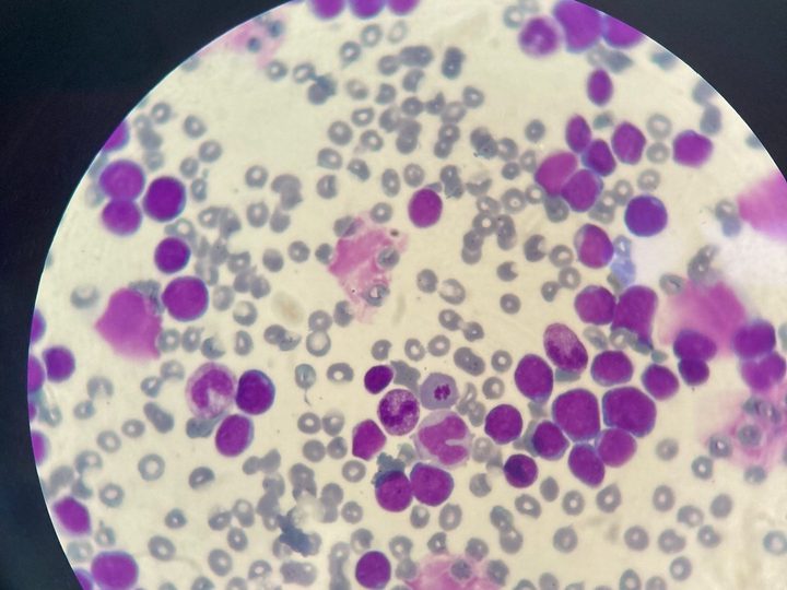Blood smear, predominance of blasts and single mature granulocytes