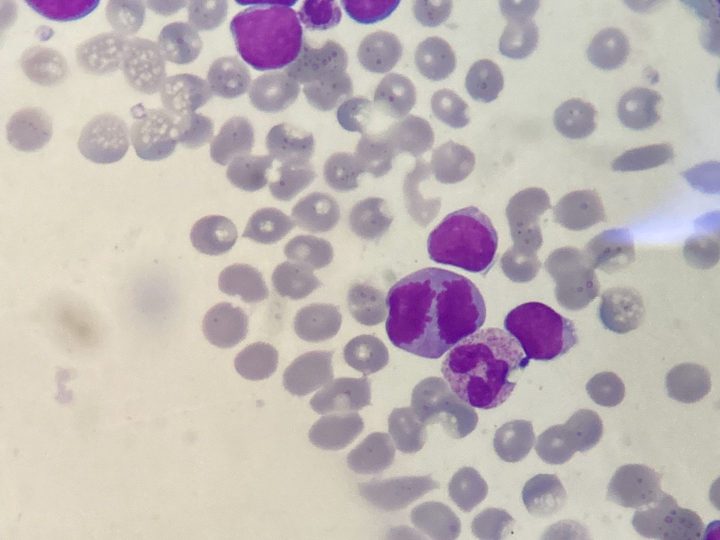 Blood smear, blasts adjacent to a segmented neutrophil