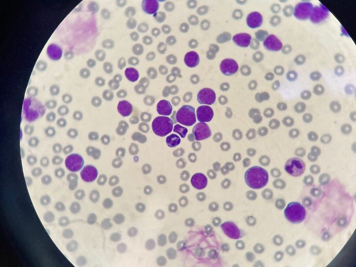 Blood smear, clusters of immature leukemic cells in the field of view