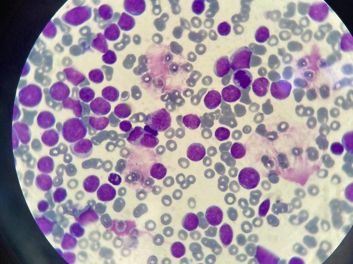 Blood smear, massive blast infiltration of peripheral blood