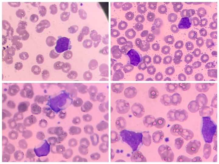 Peripheral blood smear, lymphoblasts with high nuclear-cytoplasmic ratio